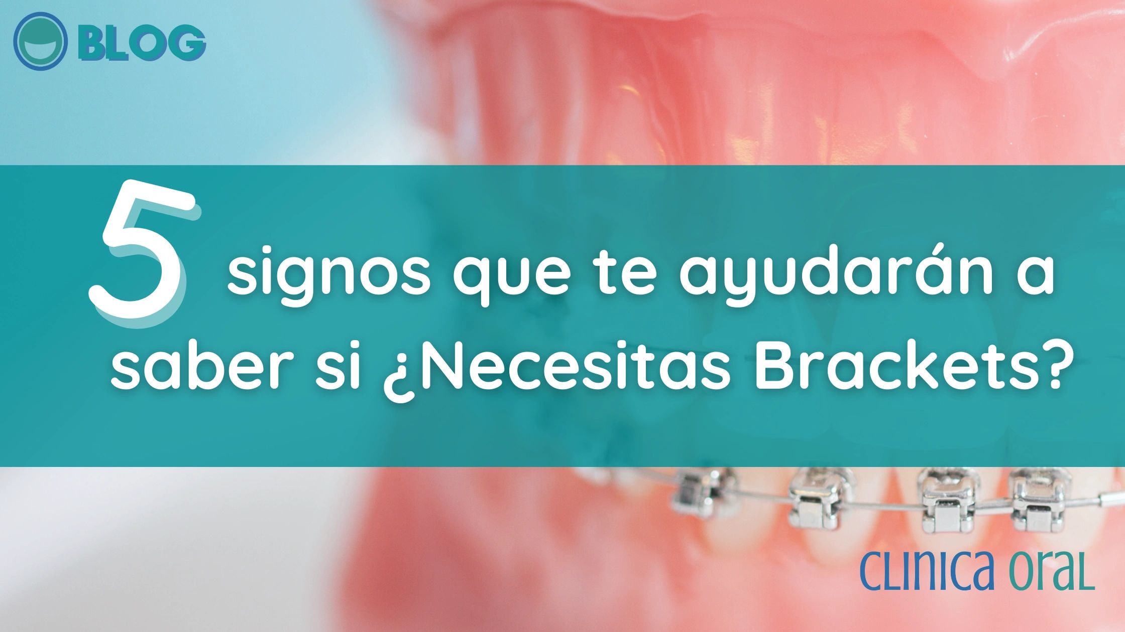 5 signos que te ayudarán a saber si Necesitas Brackets